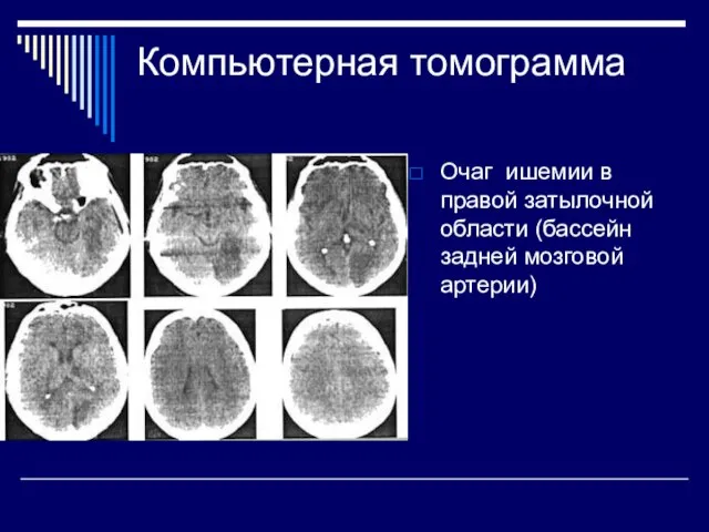 Компьютерная томограмма Очаг ишемии в правой затылочной области (бассейн задней мозговой артерии)