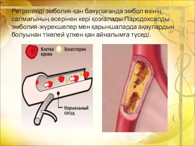 Ретрогенді эмболия-қан баяулағанда эмбол өзінің салмағының әсерінен кері қозғалады.Пародоксалды эмболия-жүрекшелер мен