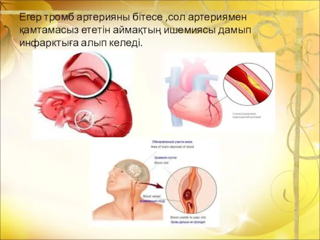 Егер тромб артерияны бітесе ,сол артериямен қамтамасыз ететін аймақтың ишемиясы дамып инфарктыға алып келеді.