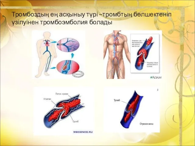 Тромбоздың ең асқыныу түрі –тромбтың бөлшектеніп үзілуінен тромбоэмболия болады