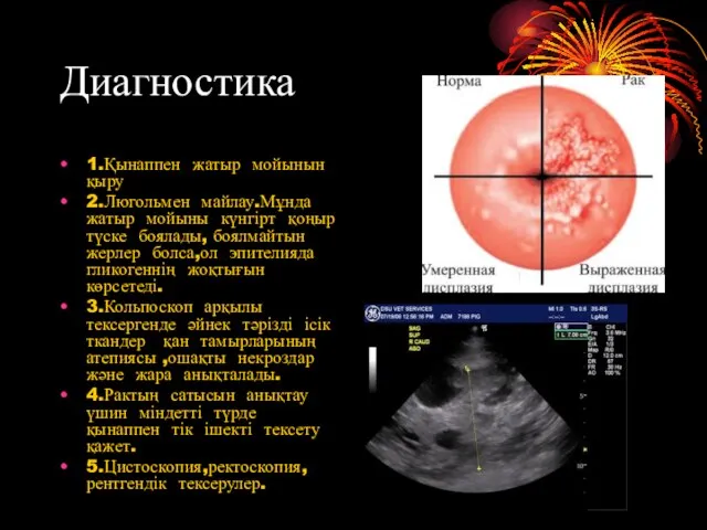 Диагностика 1.Қынаппен жатыр мойынын қыру 2.Люгольмен майлау.Мұнда жатыр мойыны күнгірт қоңыр