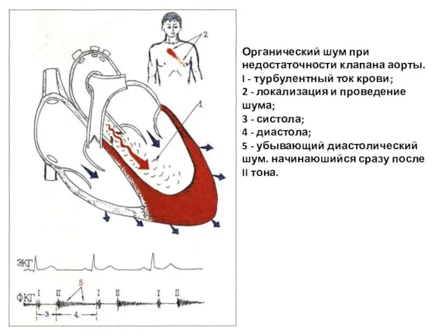 Органический шум при недостаточности клапана аорты. I - турбулентный ток крови;