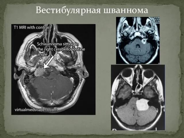 Вестибулярная шваннома