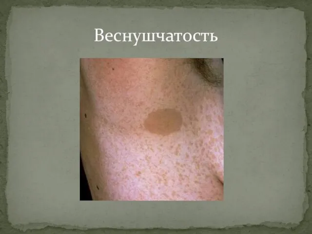 Веснушчатость