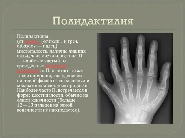 Полидактилия Полидактилия (от поли...(от поли... и греч. dáktylos — палец), многопалость,