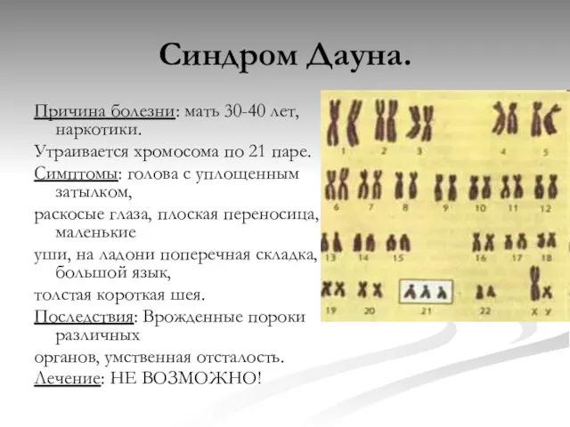 Синдром Дауна. Причина болезни: мать 30-40 лет, наркотики. Утраивается хромосома по