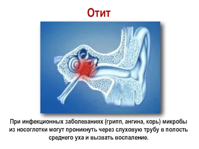 Отит При инфекционных заболеваниях (грипп, ангина, корь) микробы из носоглотки могут