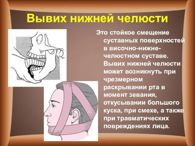 Вывих нижней челюсти Это стойкое смещение суставных поверхностей в височно-нижне-челюстном суставе.