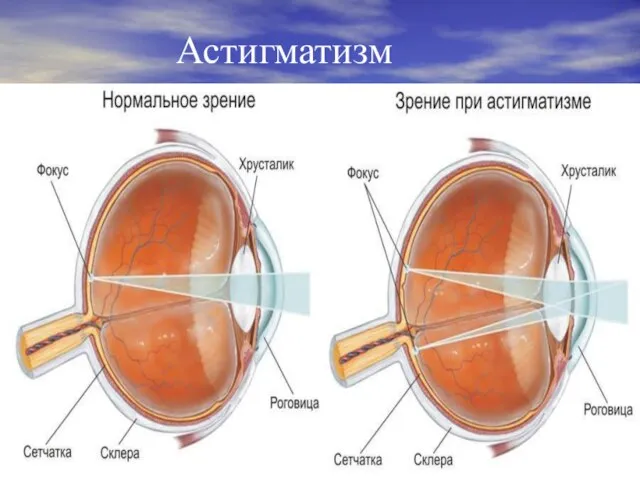 Астигматизм