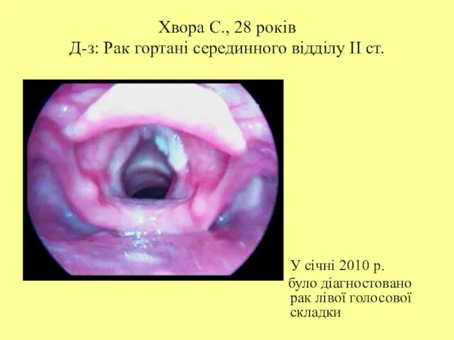 Хвора С., 28 років Д-з: Рак гортані серединного відділу ІІ ст.
