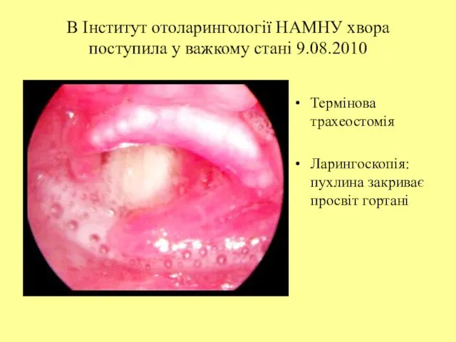 В Інститут отоларингології НАМНУ хвора поступила у важкому стані 9.08.2010 Термінова