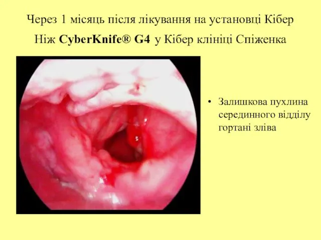 Через 1 місяць після лікування на установці Кібер Ніж CyberKnife® G4