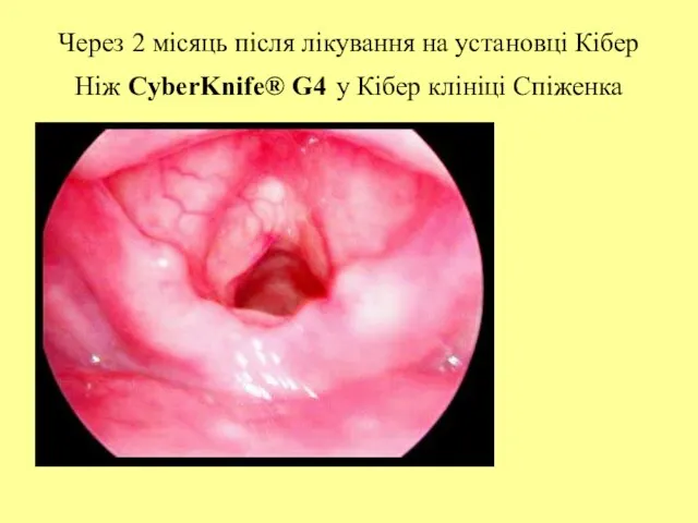 Через 2 місяць після лікування на установці Кібер Ніж CyberKnife® G4 у Кібер клініці Спіженка