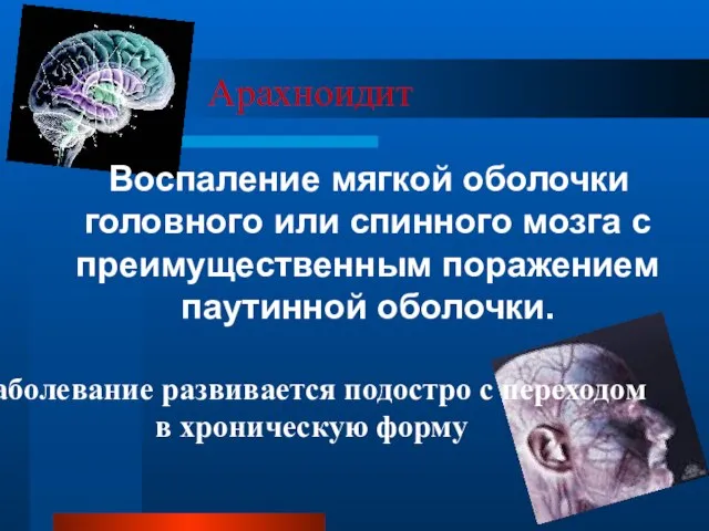 Арахноидит Воспаление мягкой оболочки головного или спинного мозга с преимущественным поражением