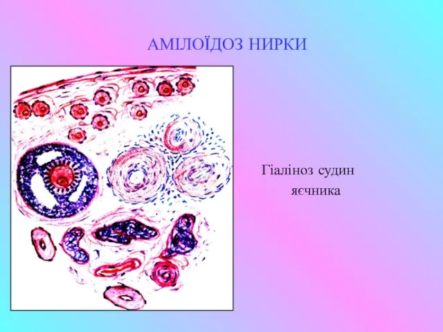 АМІЛОЇДОЗ НИРКИ Гіаліноз судин яєчника