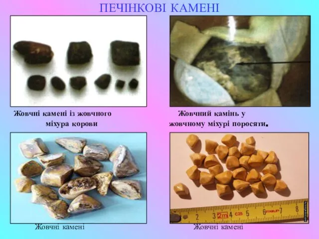 ПЕЧІНКОВІ КАМЕНІ Жовчні камені із жовчного Жовчний камінь у міхура корови