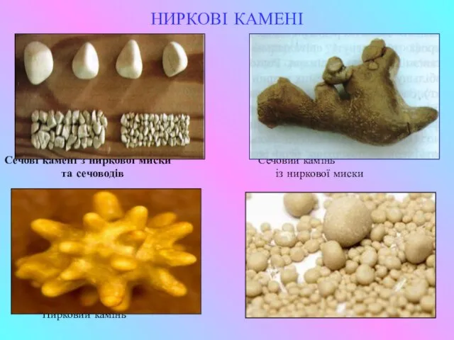 НИРКОВІ КАМЕНІ Сечові камені з ниркової миски Сечовий камінь та сечоводів