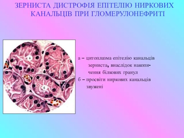 ЗЕРНИСТА ДИСТРОФІЯ ЕПІТЕЛІЮ НИРКОВИХ КАНАЛЬЦІВ ПРИ ГЛОМЕРУЛОНЕФРИТІ а – цитоплазма епітелію