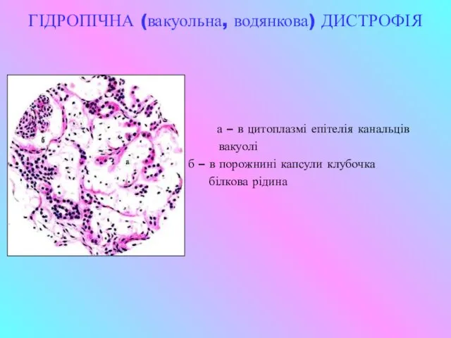 ГІДРОПІЧНА (вакуольна, водянкова) ДИСТРОФІЯ а – в цитоплазмі епітелія канальців вакуолі