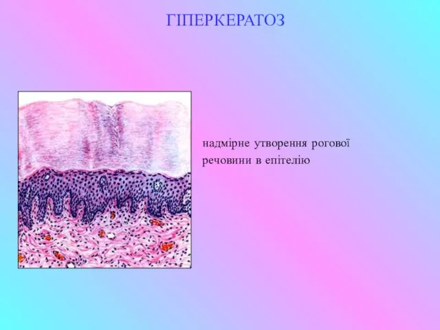 ГІПЕРКЕРАТОЗ надмірне утворення рогової речовини в епітелію