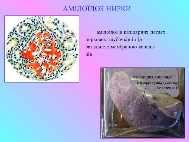 АМІЛОЇДОЗ НИРКИ амілоїдоз в капілярних петлях ниркових клубочків і під базальною мембраною каналь- ців