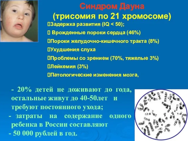 - 20% детей не доживают до года, остальные живут до 40-50лет