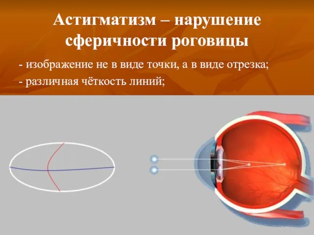 Астигматизм – нарушение сферичности роговицы - изображение не в виде точки,