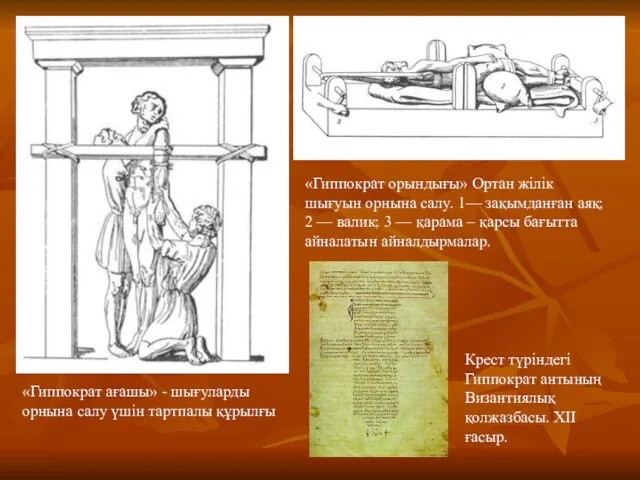 «Гиппократ ағашы» - шығуларды орнына салу үшін тартпалы құрылғы «Гиппократ орындығы»