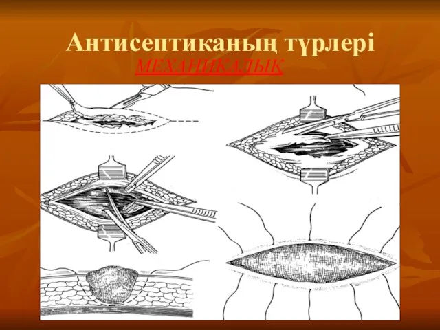 Антисептиканың түрлері МЕХАНИКАЛЫҚ