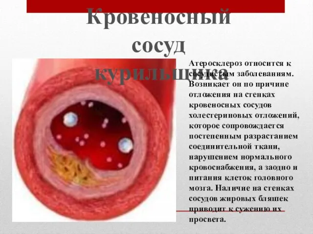 Кровеносный сосуд курильщика Атеросклероз относится к сосудистым заболеваниям. Возникает он по