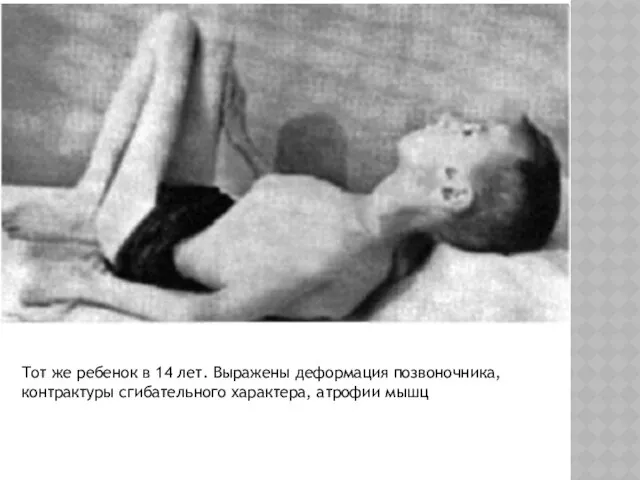 Тот же ребенок в 14 лет. Выражены деформация позвоночника, контрактуры сгибательного характера, атрофии мышц