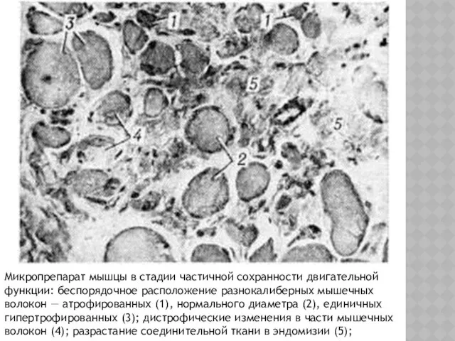 Микропрепарат мышцы в стадии частичной сохранности двигательной функции: беспорядочное расположение разнокалиберных