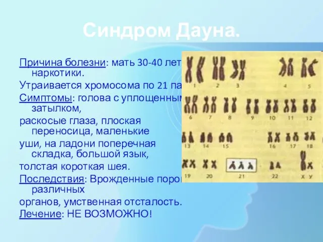 Синдром Дауна. Причина болезни: мать 30-40 лет, наркотики. Утраивается хромосома по