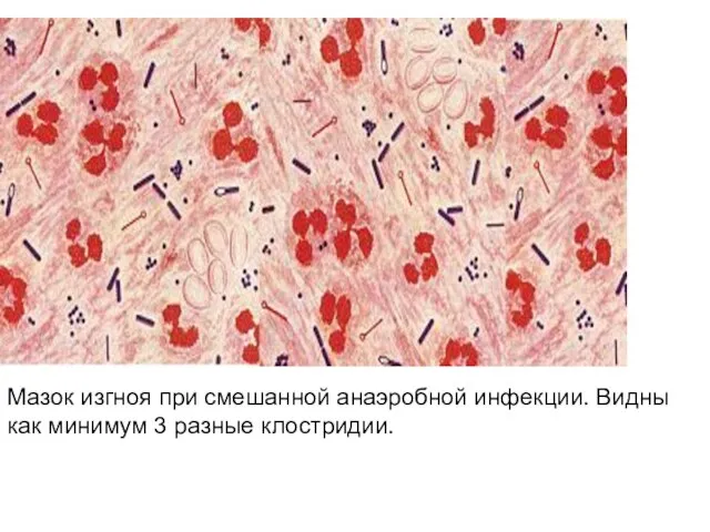 Мазок изгноя при смешанной анаэробной инфекции. Видны как минимум 3 разные клостридии.