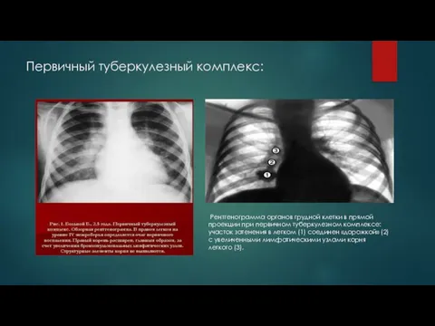Первичный туберкулезный комплекс: Рентгенограмма органов грудной клетки в прямой проекции при
