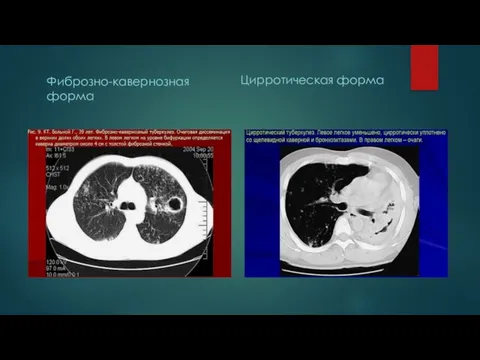 Фиброзно-кавернозная форма Цирротическая форма