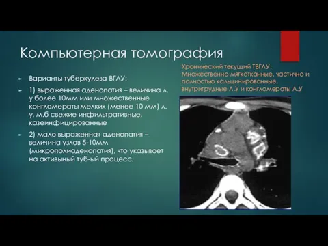 Компьютерная томография Варианты туберкулеза ВГЛУ: 1) выраженная аденопатия – величина л.у