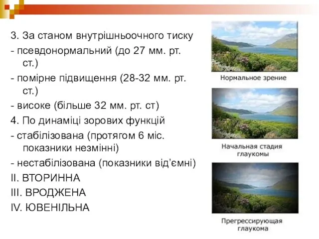 3. За станом внутрішньоочного тиску - псевдонормальний (до 27 мм. рт.