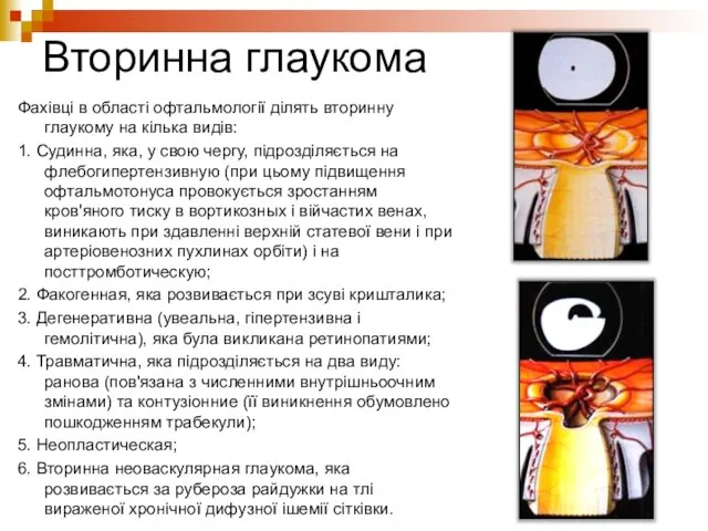 Вторинна глаукома Фахівці в області офтальмології ділять вторинну глаукому на кілька