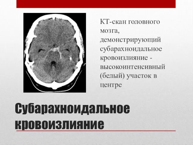 Субарахноидальное кровоизлияние КТ-скан головного мозга, демонстрирующий субарахноидальное кровоизлияние - высокоинтенсивный (белый) участок в центре