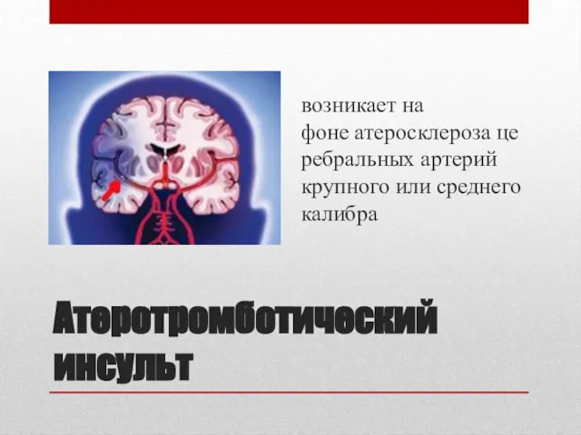 Атеротромботический инсульт возникает на фоне атеросклероза церебральных артерий крупного или среднего калибра