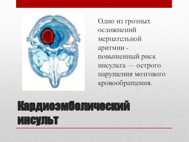 Кардиоэмболический инсульт Одно из грозных осложнений мерцательной аритмии - повышенный риск