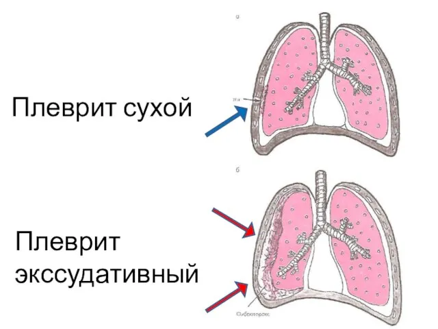 Плеврит сухой Плеврит экссудативный