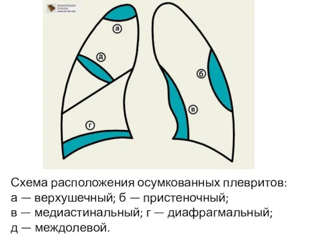 Схема расположения осумкованных плевритов: а — верхушечный; б — пристеночный; в