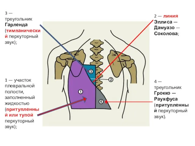 1 — участок плевральной полости, заполненный жидкостью (притупленный или тупой перкуторный