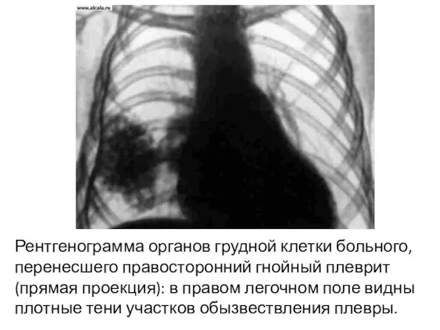 Рентгенограмма органов грудной клетки больного, перенесшего правосторонний гнойный плеврит (прямая проекция):