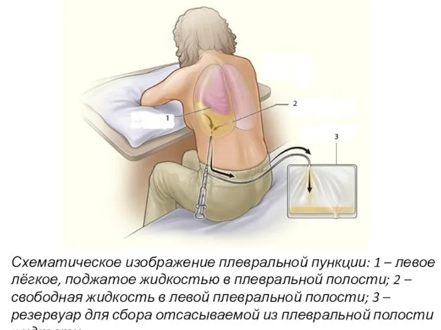 Схематическое изображение плевральной пункции: 1 – левое лёгкое, поджатое жидкостью в