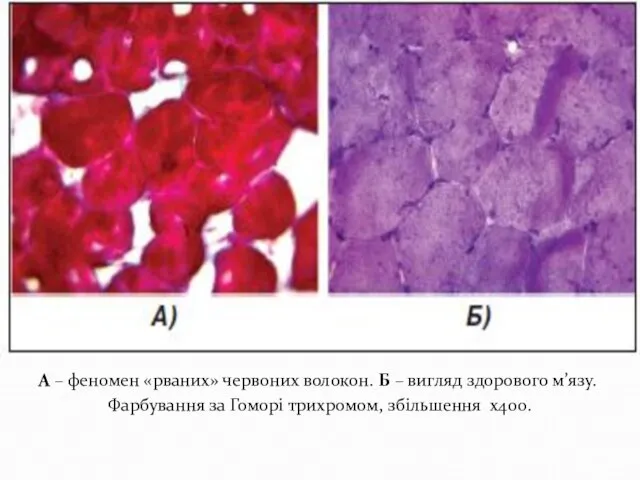 А – феномен «рваних» червоних волокон. Б – вигляд здорового м’язу.