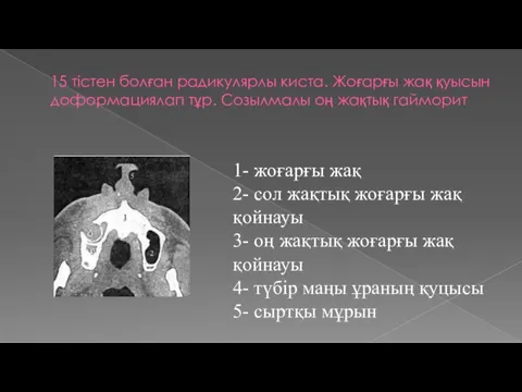 15 тістен болған радикулярлы киста. Жоғарғы жақ қуысын доформациялап тұр. Созылмалы