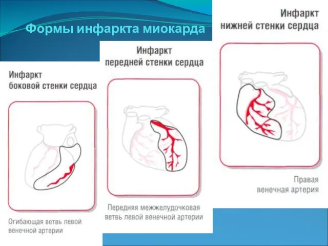 Формы инфаркта миокарда